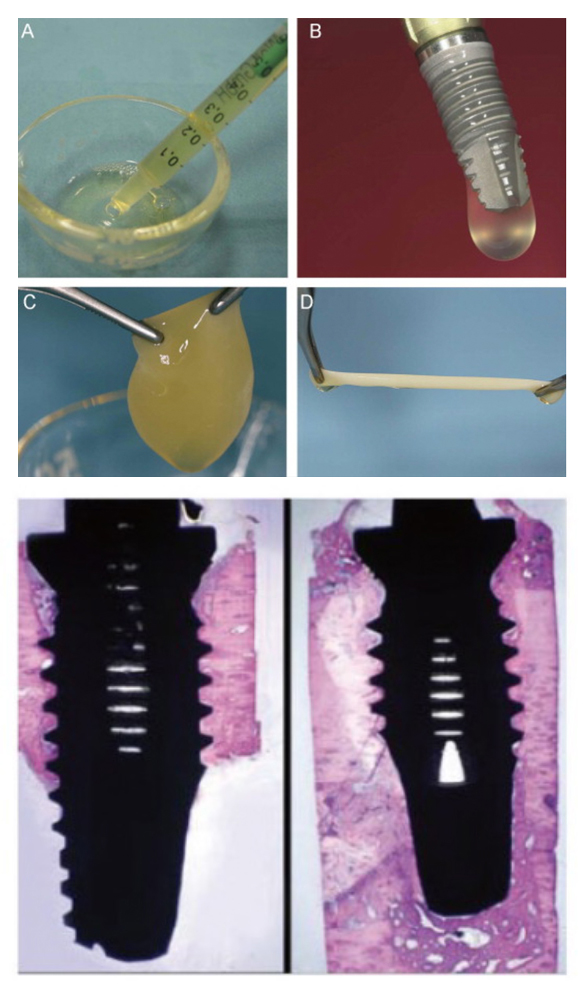 インプラント PRGF